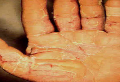 شکل 3: عوارض پوستی کار با آب صابون